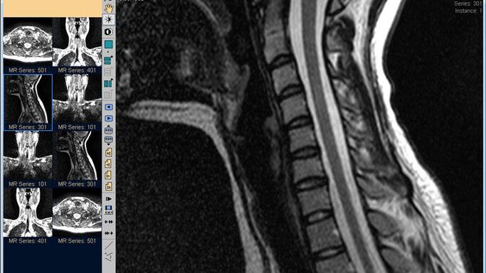 Emakakaela lülisamba MRI on parim meetod kaelavalu diagnoosimiseks